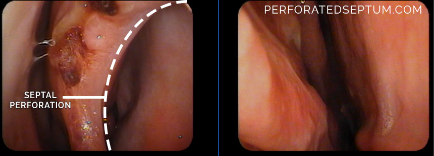 perforated septum