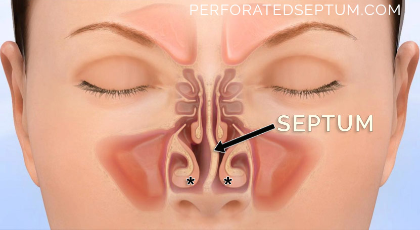 perforated septum treatment