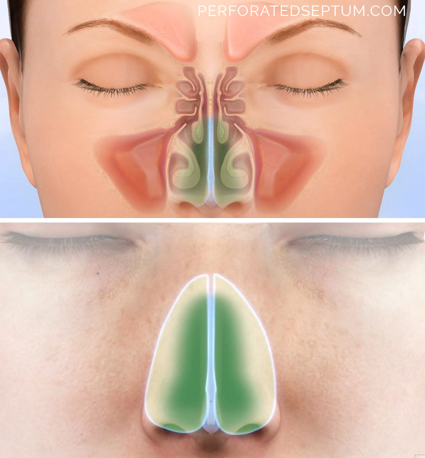surgery nasal septum