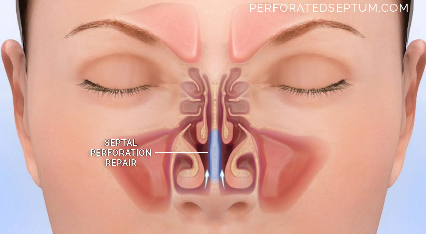 Perforated Septum nasal congestion diagram 